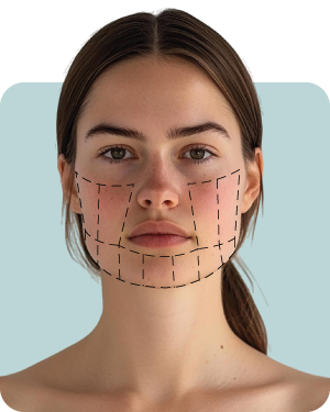 Ultherapy